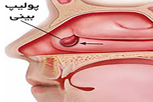 علائم و درمان پولیپ بینی