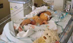 انجام عمل جراحی میلومنگوسل بر روی نوزاد چهار روزه در یاسوج انجام عمل جراحی میلومنگوسل بر روی نوزاد چهار روزه در یاسوج